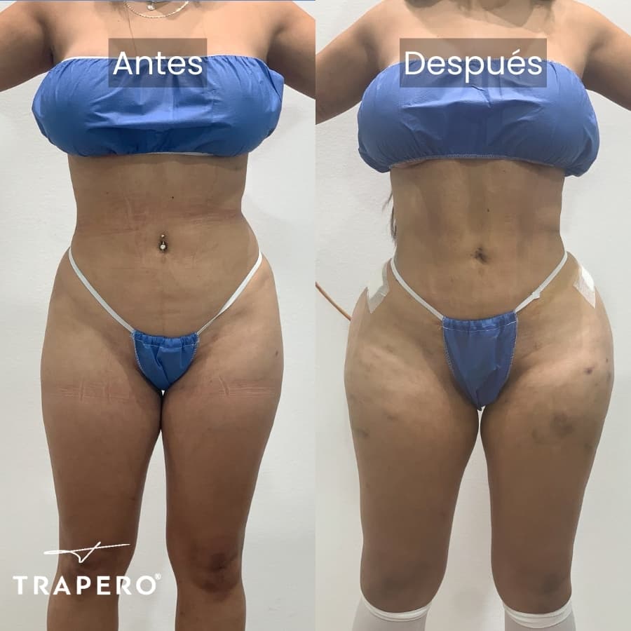 como se ven los implantes de cadera