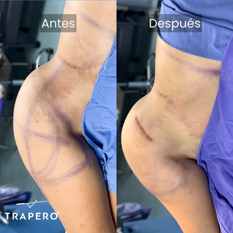 como voy a quedar con implantes de cadera