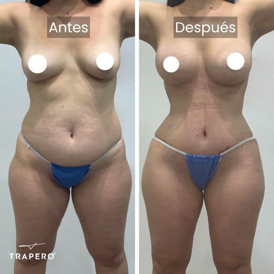 mommy makeover tiempo de recuperacion