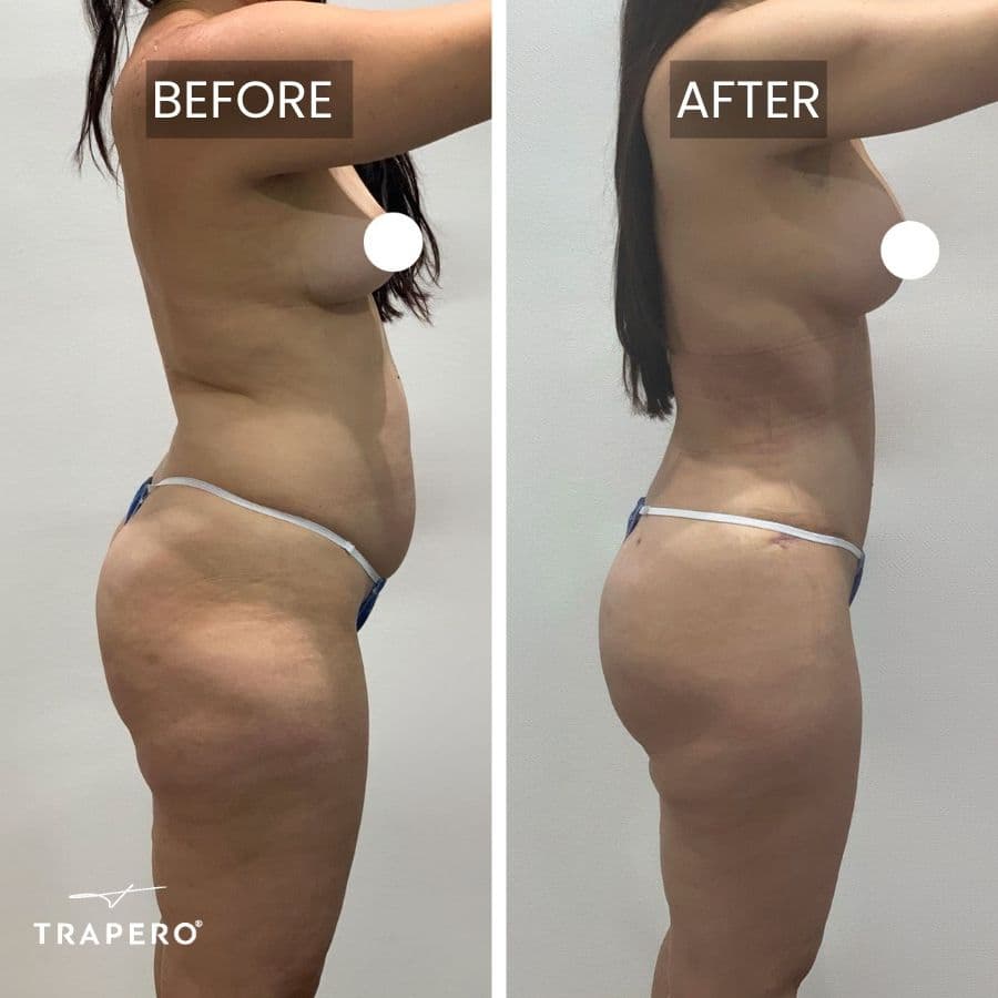 mommy makeover surgery