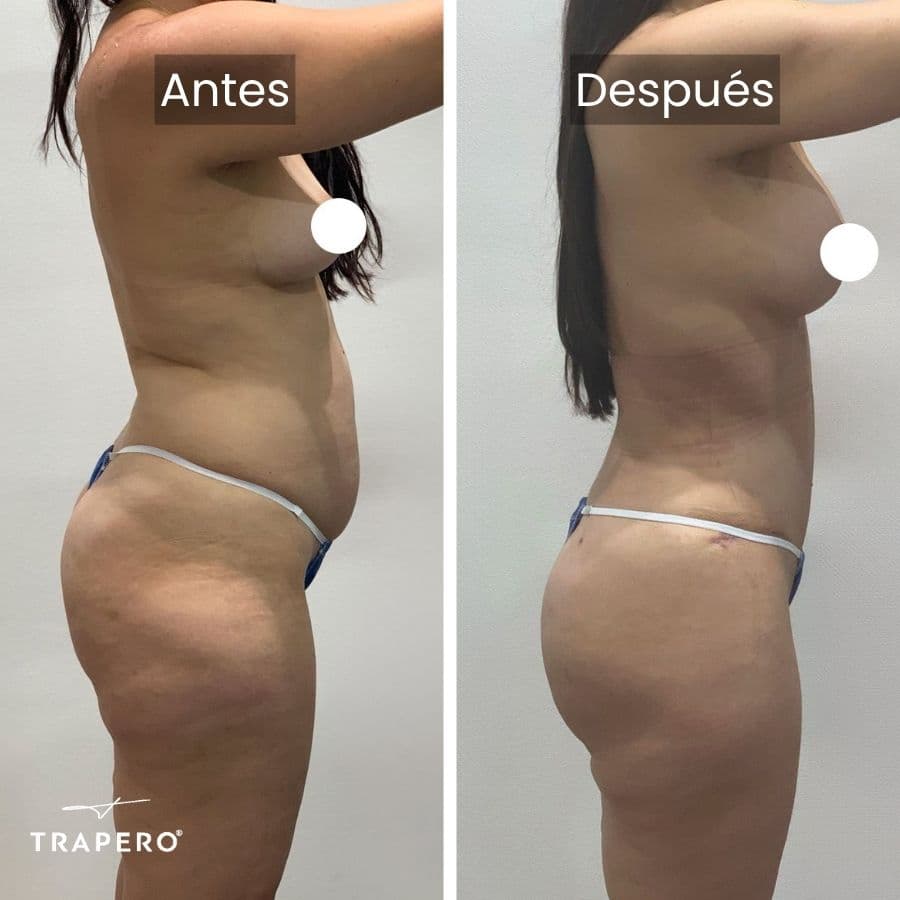 mommy makeover costo