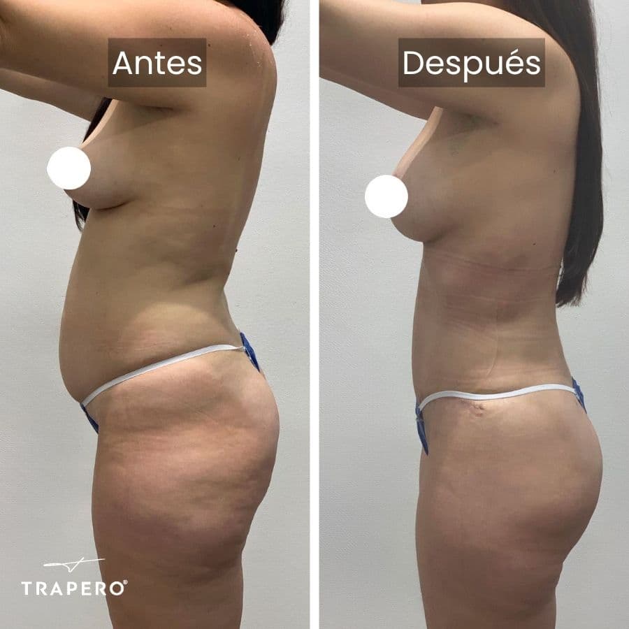 mommy makeover como voy a quedar