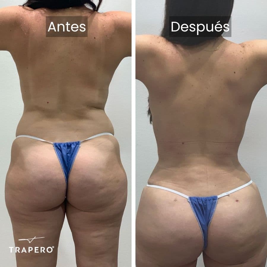 mommy makeover como me voy a ver