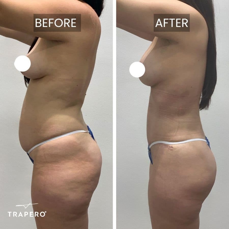 mommy makeover liposuction