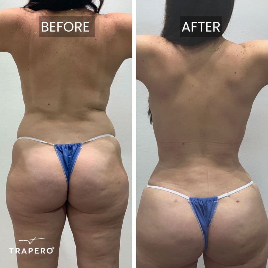 mommy makeover surgery results