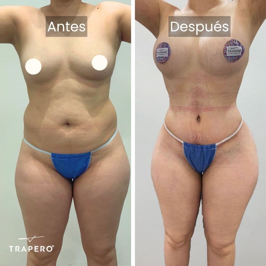 mommy makeover resultados