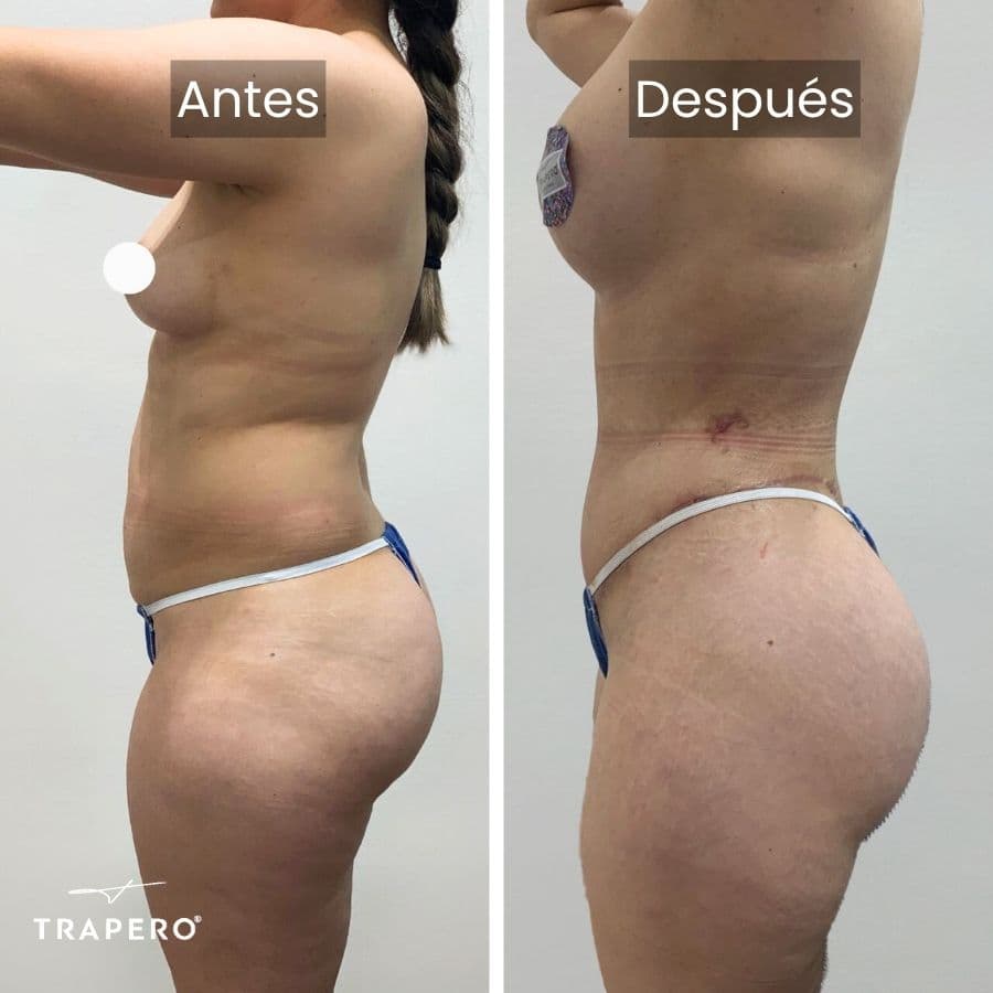 cuanto cuesta un mommy makeover