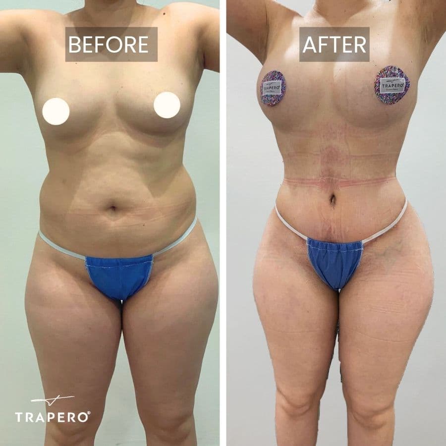 mommy makeover before and after