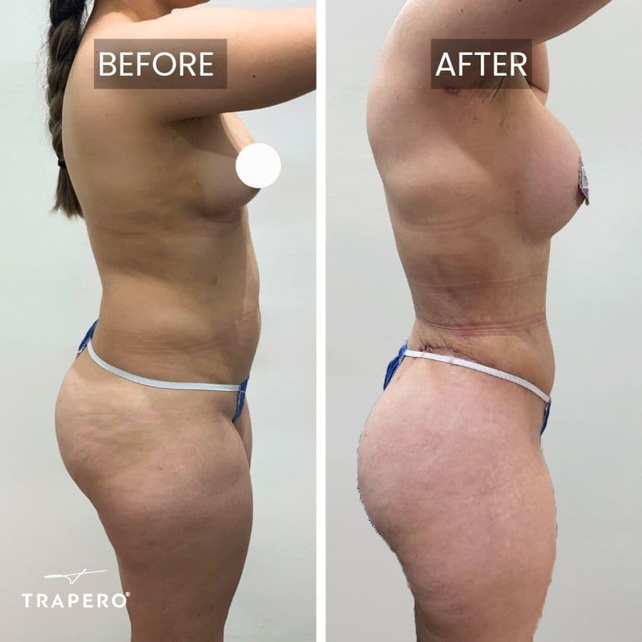 tummy tuck before and after