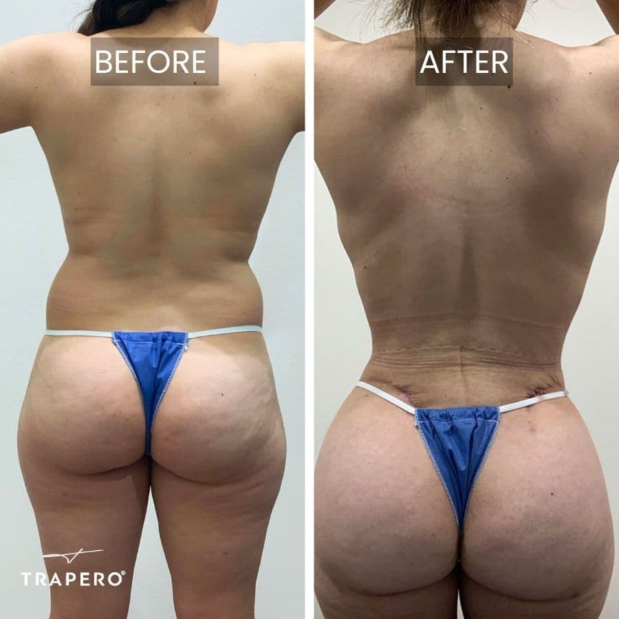 tummy tuck results