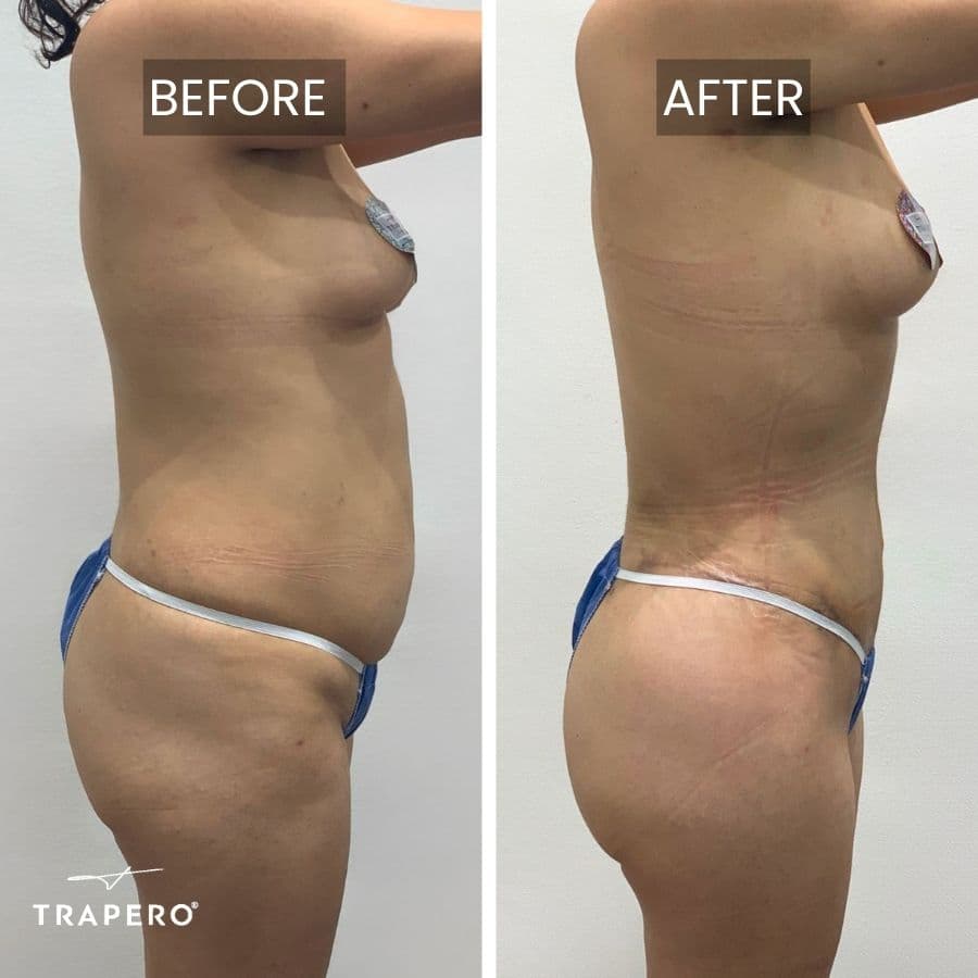 mommy makeover cost tijuana