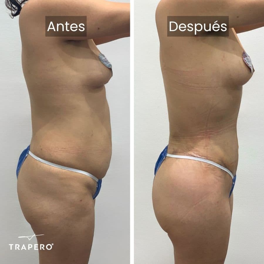 mommy makeover vaser