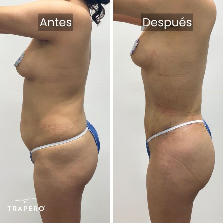 abdominoplastia resultados 