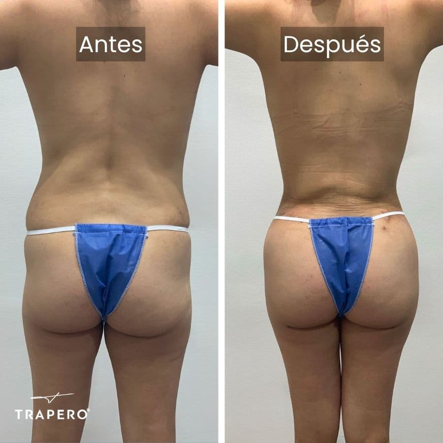 cirugia de gluteo