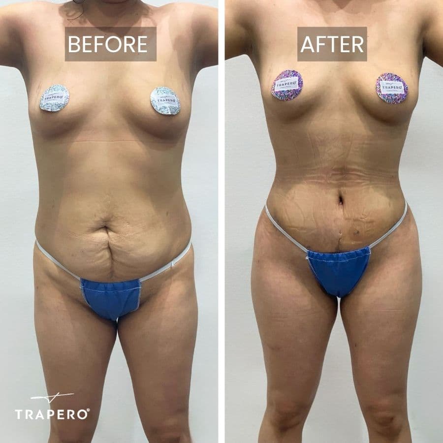 tummy tuck cost mexico