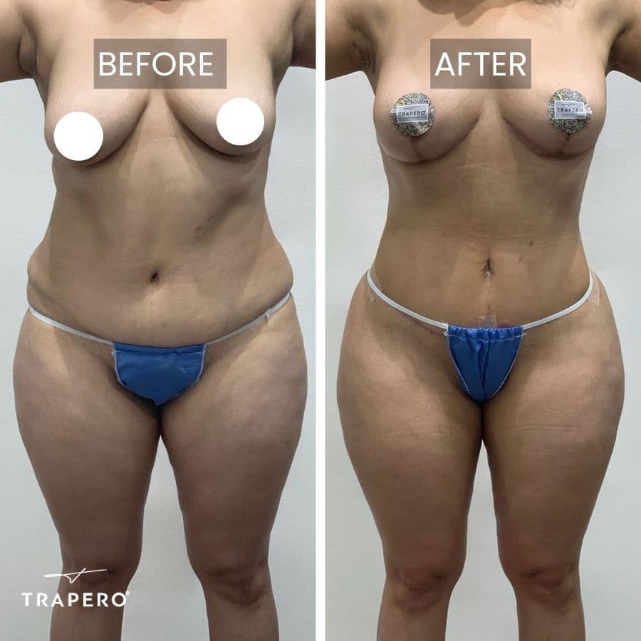 tummy tuck surgeon