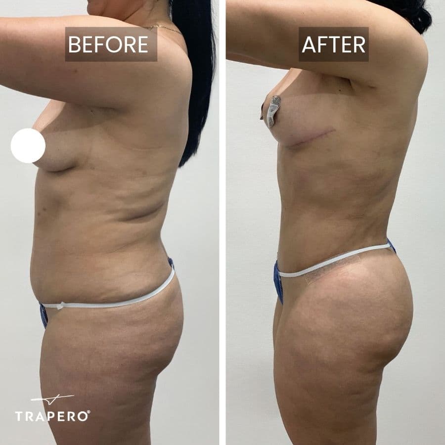 tummy tuck flat stomach