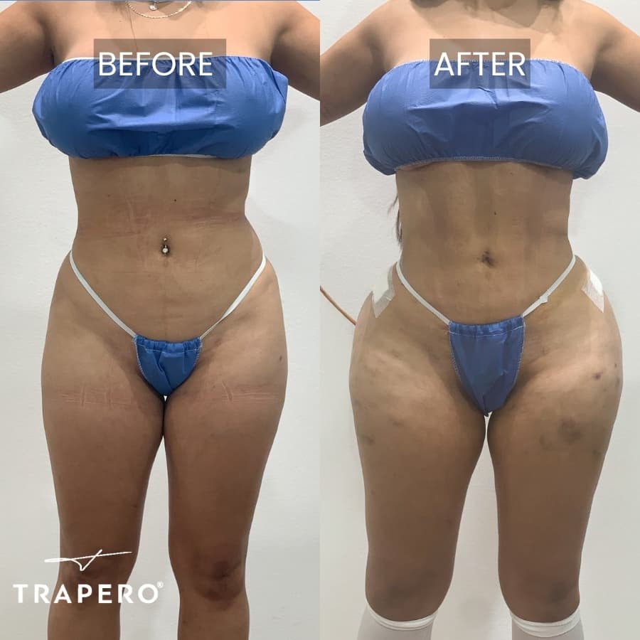 hip implantes in mexico