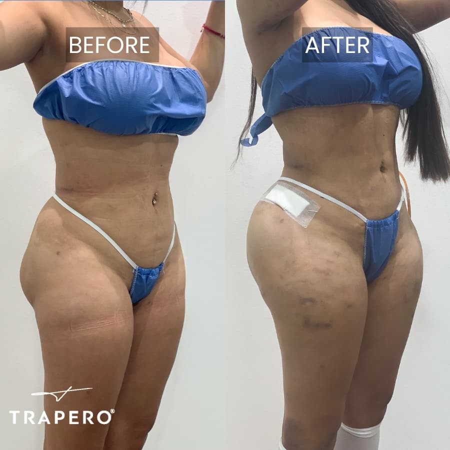 hip implants in tijuana